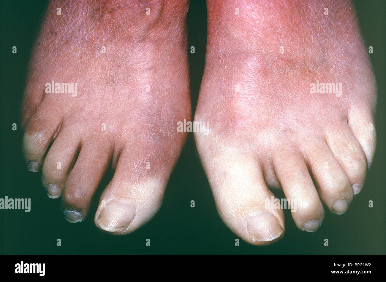 In medicine, Raynaud's phenomenon is a vasospastic disorder causing