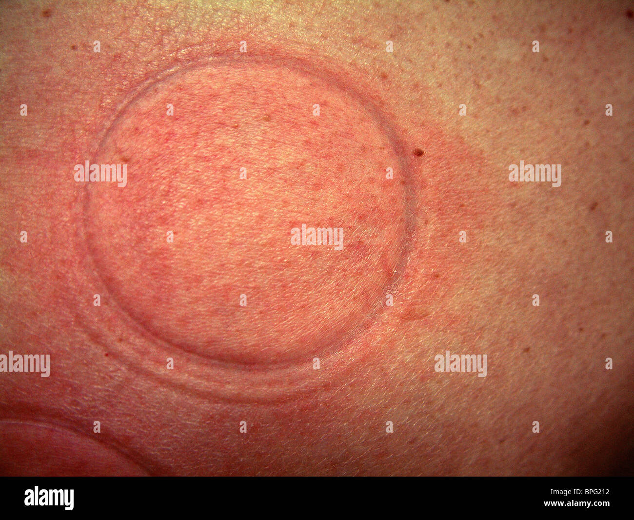 A photograph showing a round mark on the skin, 40mm in diameter  which has been produced by Cupping Therapy Stock Photo