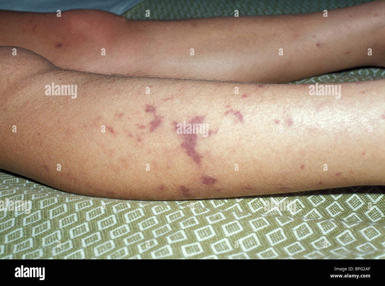 Purpuric rash on lower legs in meningococcal septicaemia in young girl who made full recovery. Stock Photo