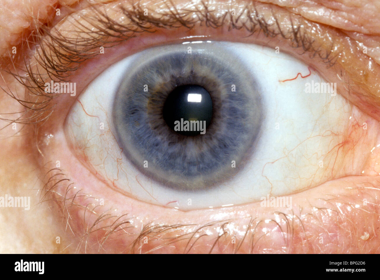 Corneal arcus appears as a whitish ring on the peripheral cornea with a clear zone between it and the limbus. Stock Photo