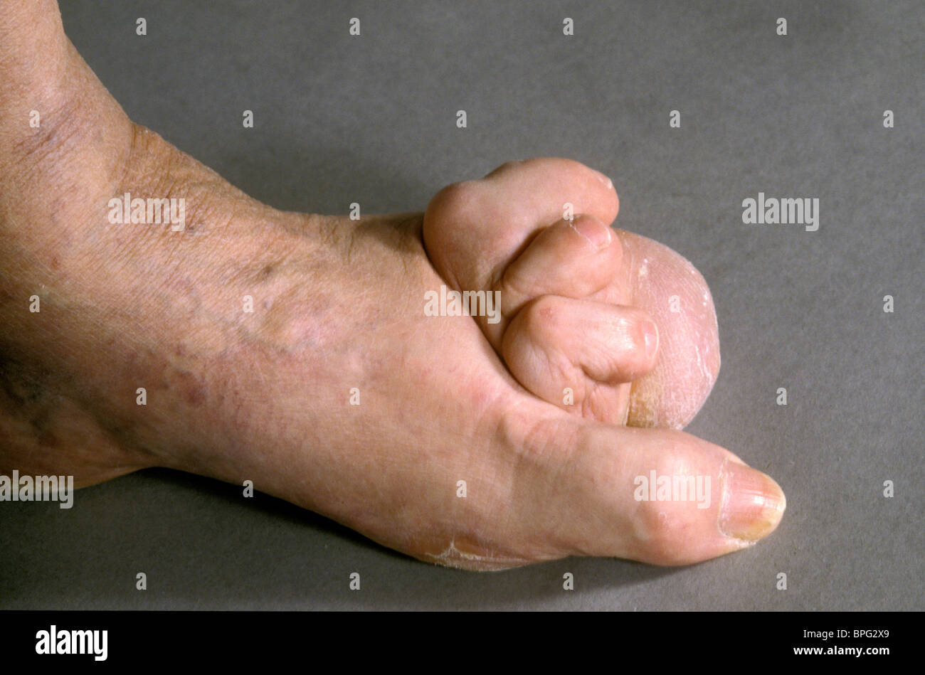 Deformity of the toes in a patient suffering from rheumatoid arthritis. Stock Photo