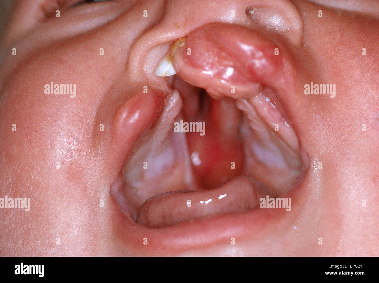 This is a congenital deformity caused by abnormal facial development during gestation. Stock Photo