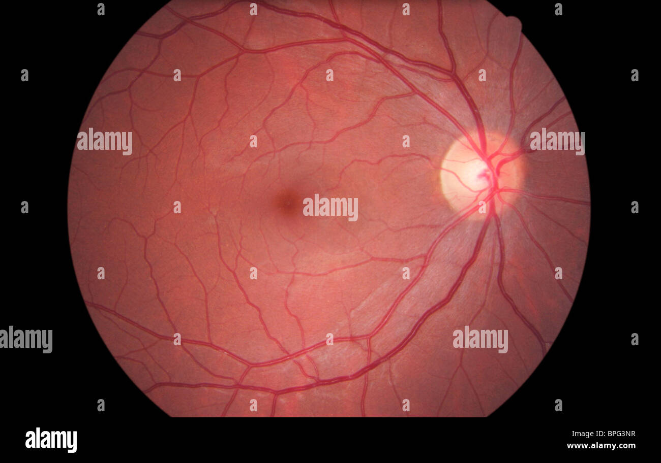 Fundus camera image of the retina of a normal eye, showing the distribution of the retinal veins & arteries. Stock Photo