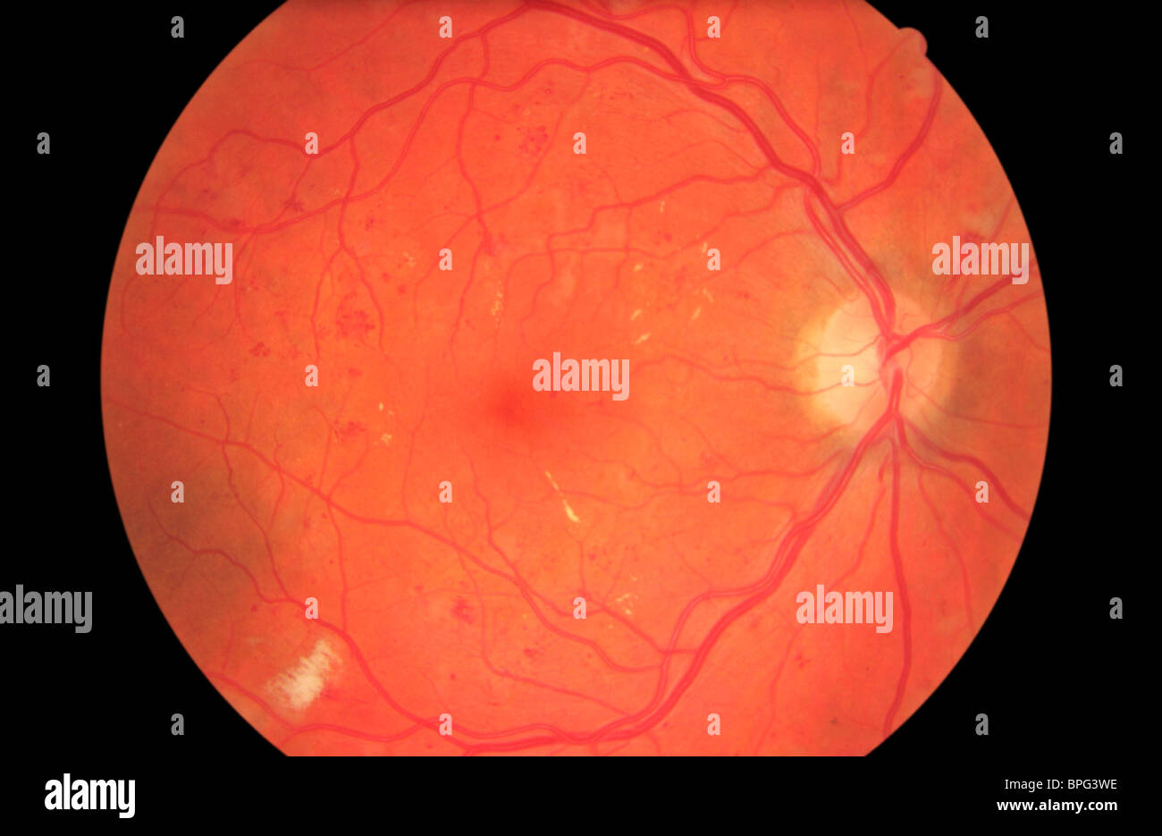 Preproliferative diabetic retinopathy is a more advanced stage of damage to the eye than the early signs found in BDR. Stock Photo