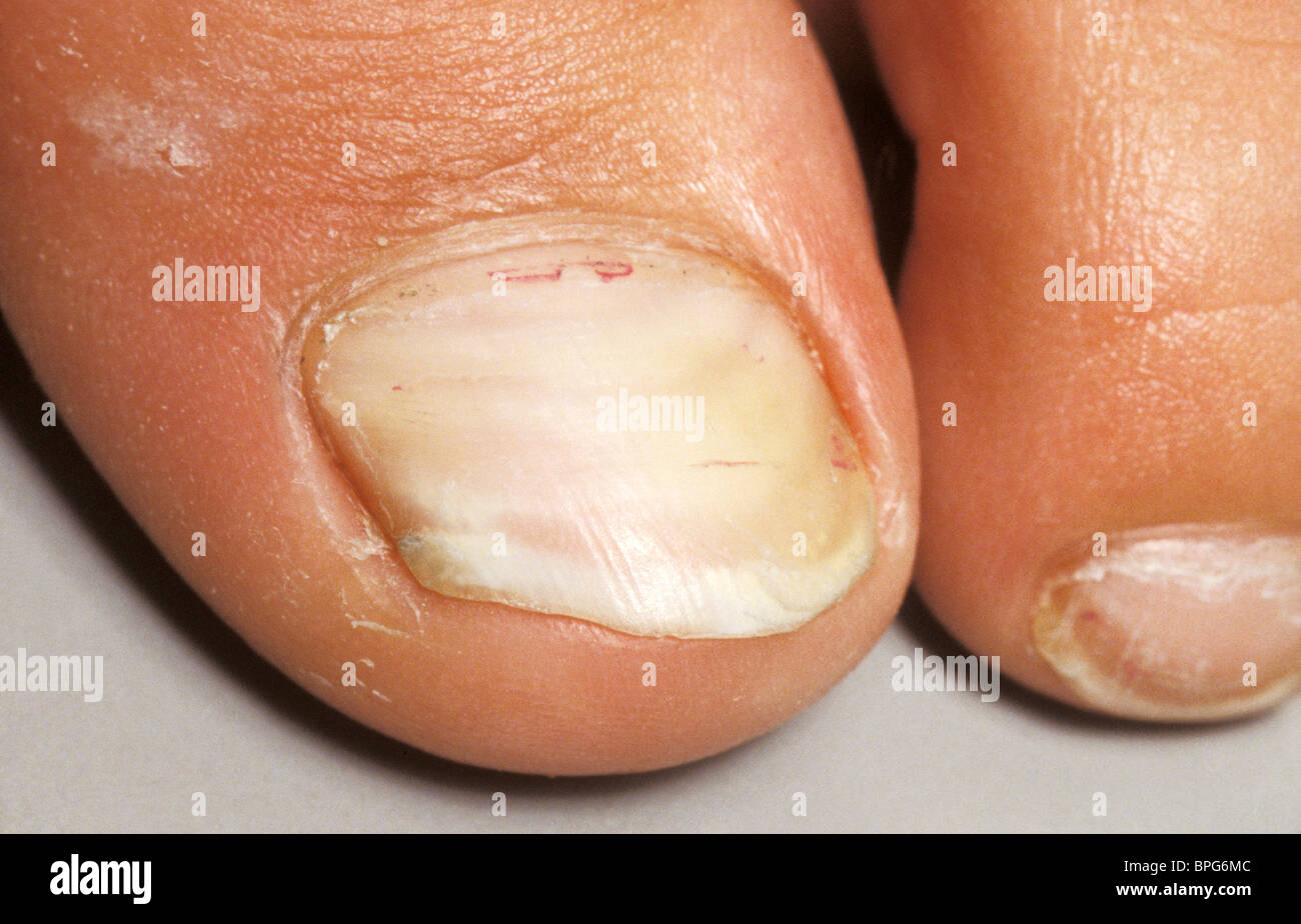 Congenital leukonychia of toenails, leukonychia is the most common chromatic abnormality of the nail. Stock Photo