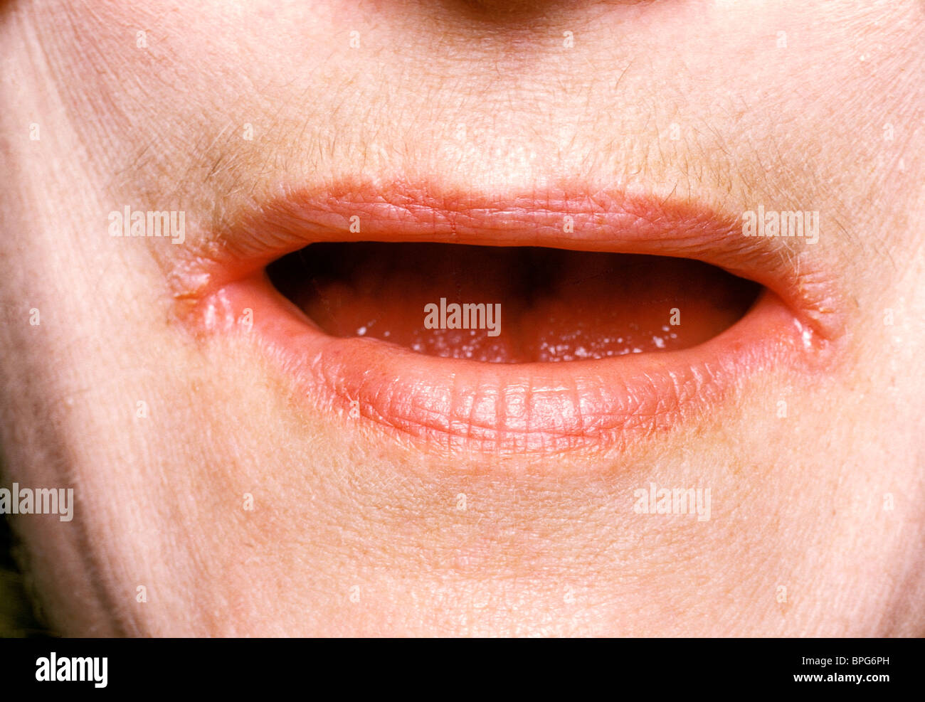 Female with Angular Stomatitis resulting in cracking & splitting of tissues at the junction of the upper & lower lips. Stock Photo