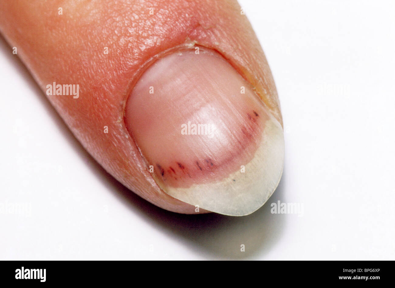 What causes black lines in nails? How can you treat it? - Quora