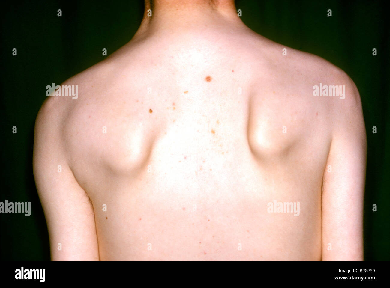 Landouzy-Dejerine Syndrome which causes scapula winging Stock Photo - Alamy