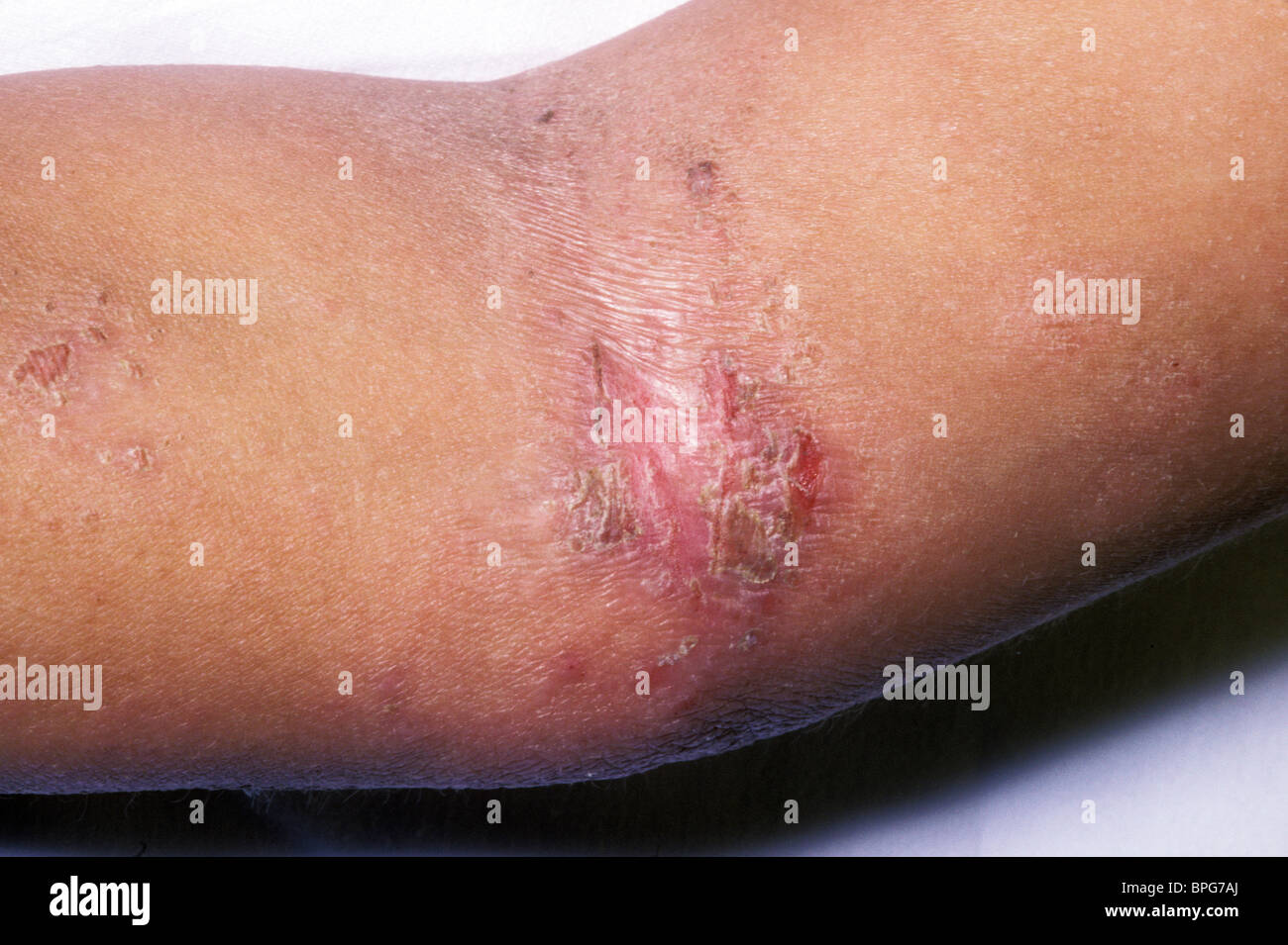 Eczematous dermatitis hires stock photography and images Alamy
