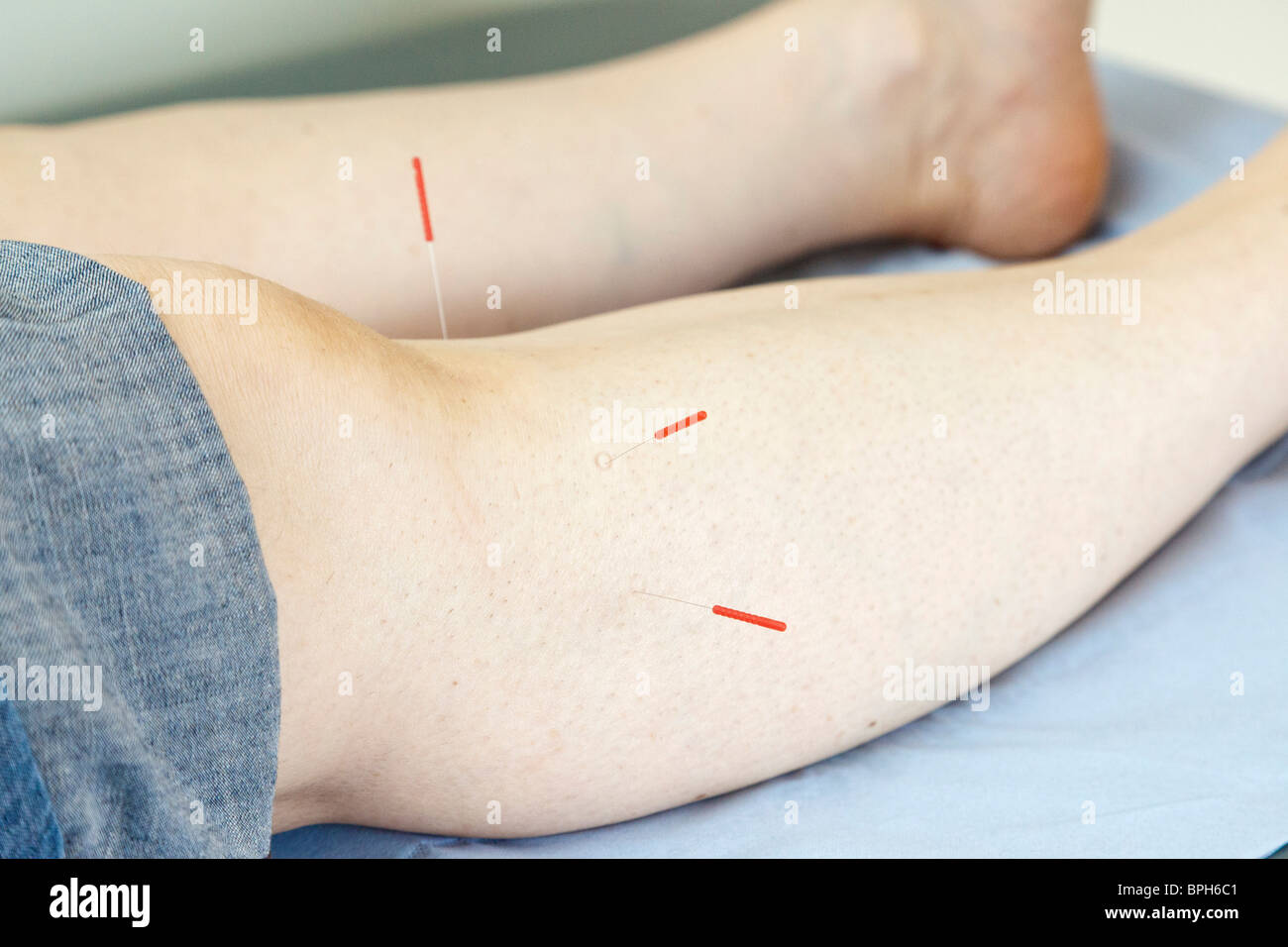 acupuncture needles in a patient Stock Photo Alamy
