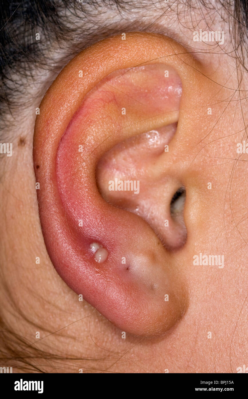 Infected ear after making holes for ear rings. Stock Photo