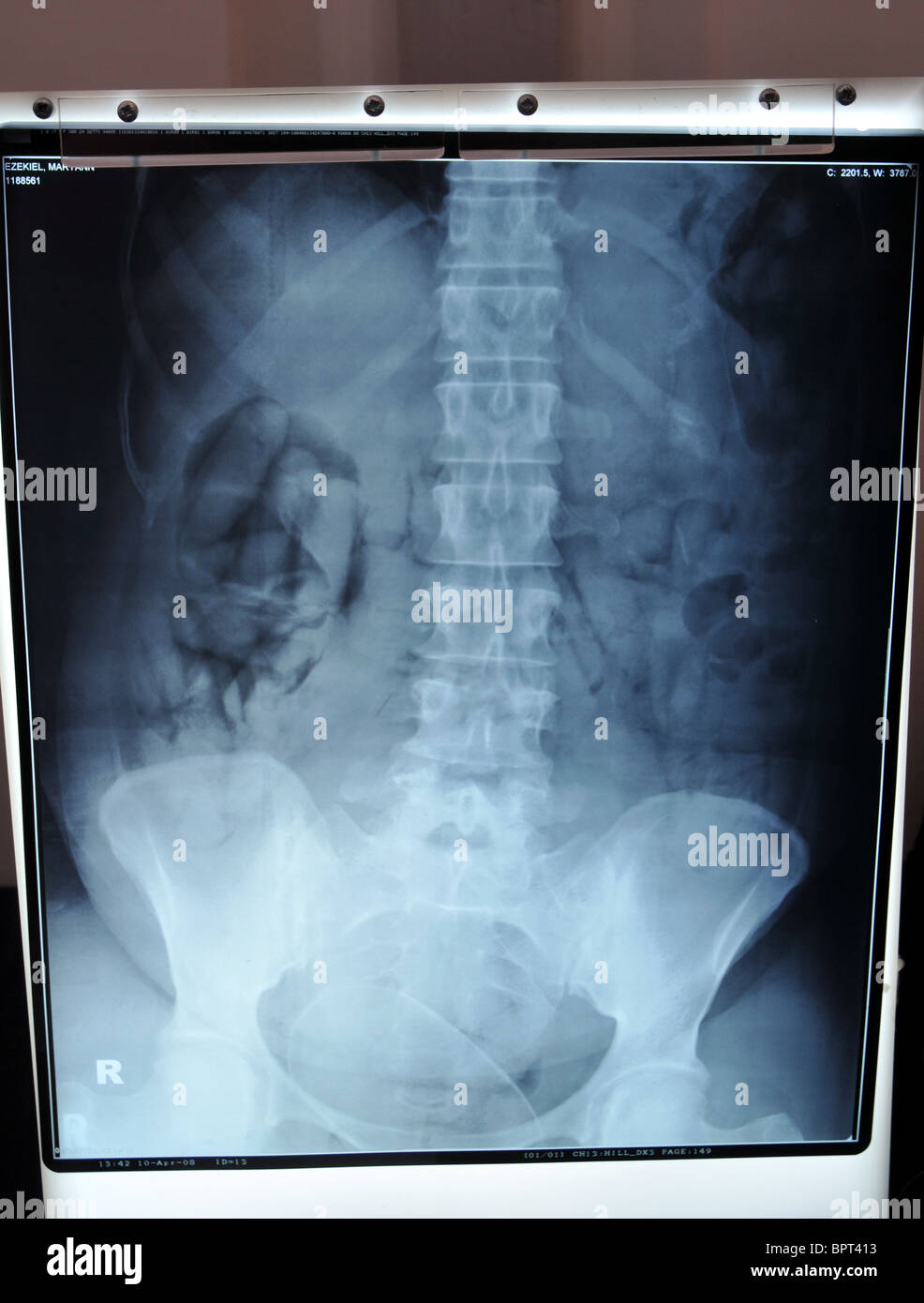 Drug smuggling seizures by The UK Border Agency. X-ray showing taped up packets that were swallowed by a drug smuggler Stock Photo