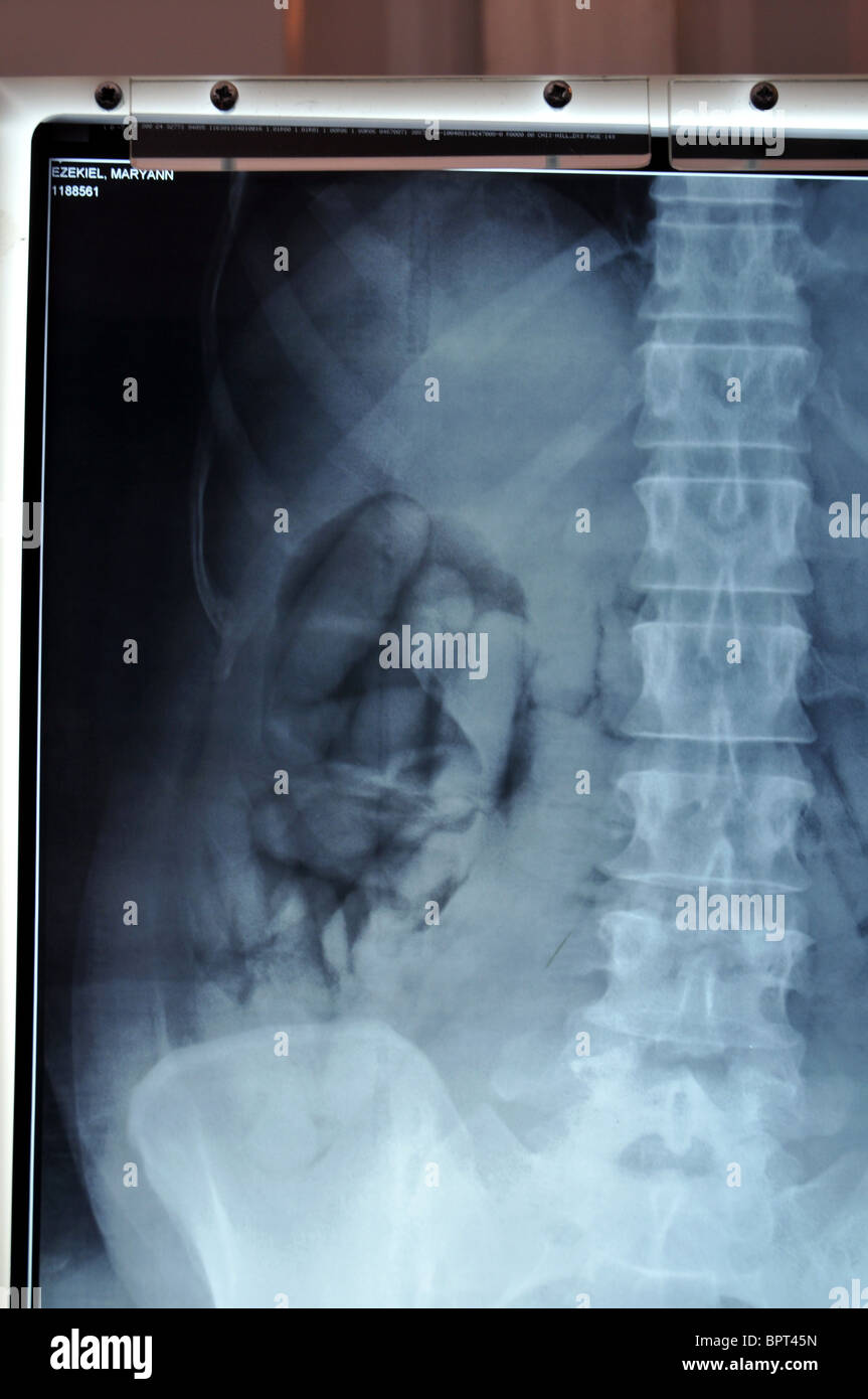 Drug smuggling seizures by The UK Border Agency. X-ray showing taped up packets that were swallowed by a drug smuggler Stock Photo