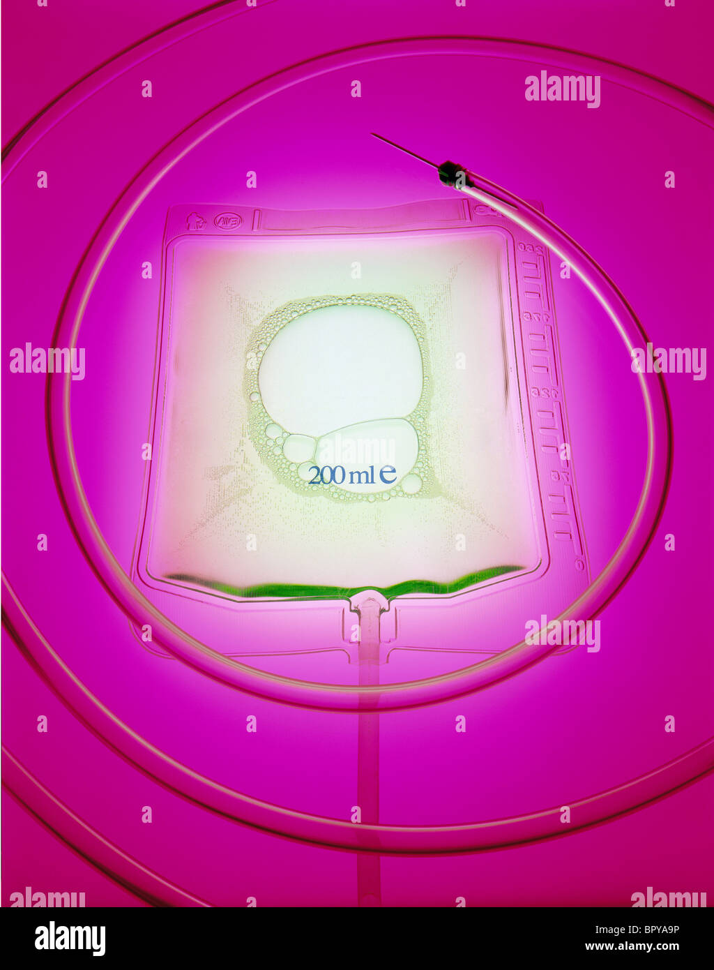 IV bag  with a tube and a needle shot on illuminating pink background. Tube and needle are creating a circular pattern. Stock Photo