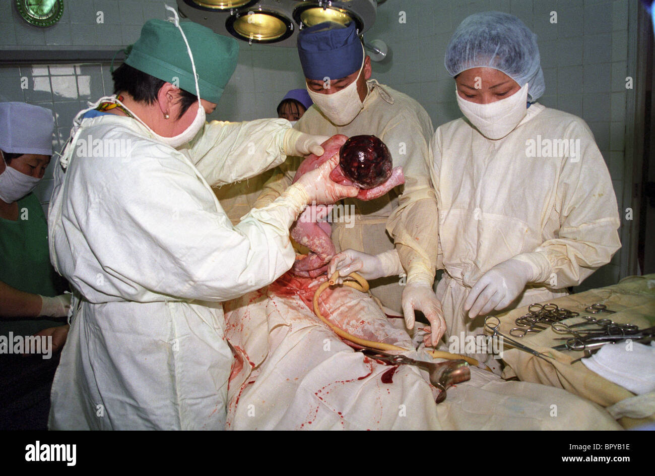 Caesarian section in Mongolia Stock Photo
