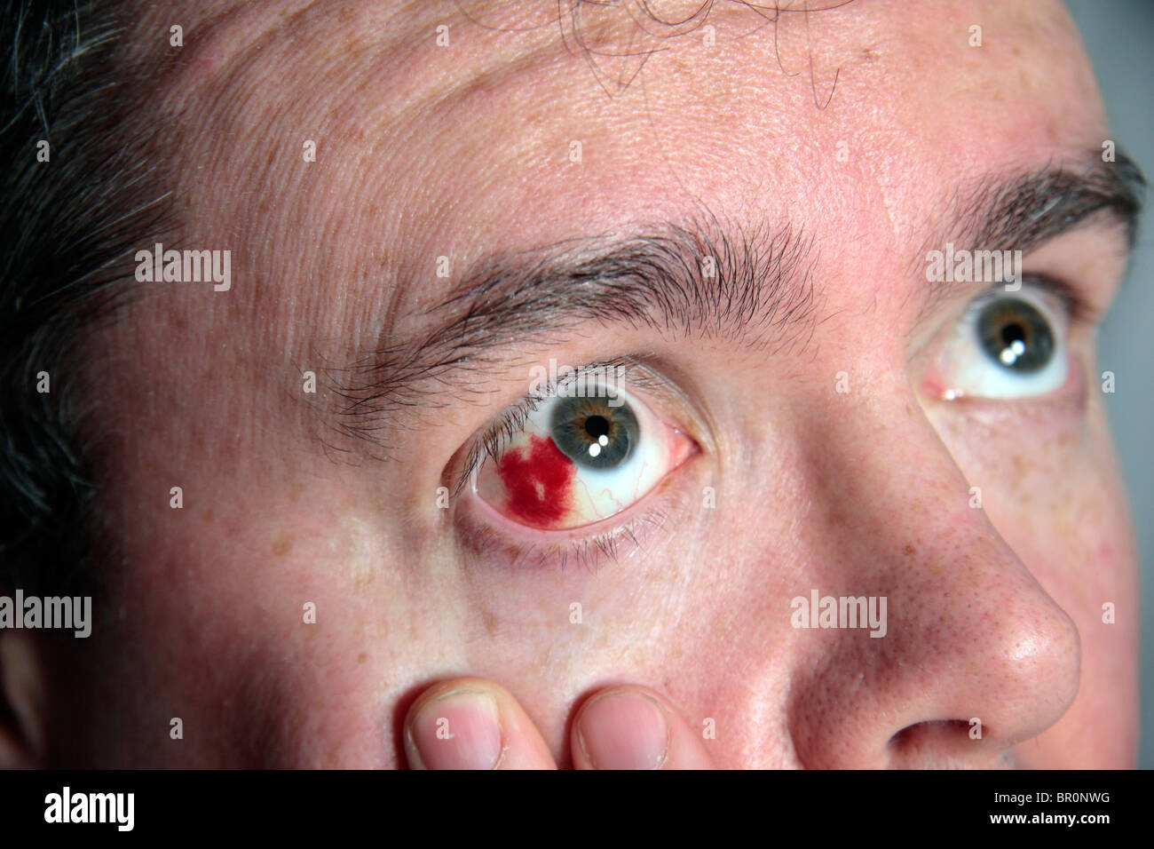 A sore bloodshot red eye on a white British man. Stock Photo