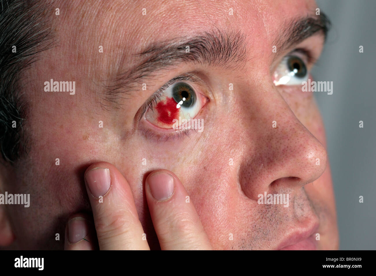 A sore bloodshot red eye on a white British man. Stock Photo