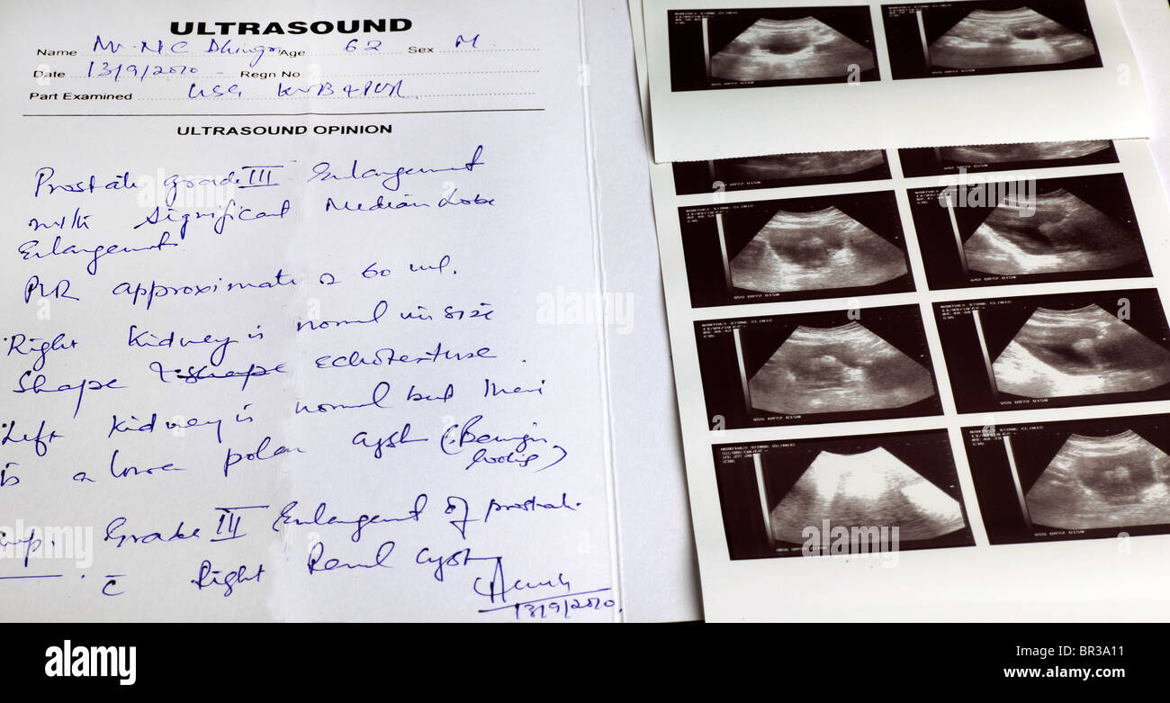 Enlarged Prostate Ultrasound