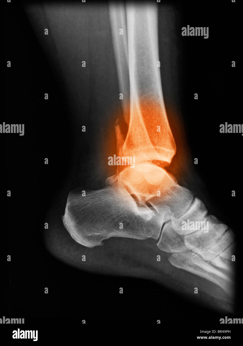 X-ray showing a bimalleolar ankle fracture in a 50 year old woman Stock Photo