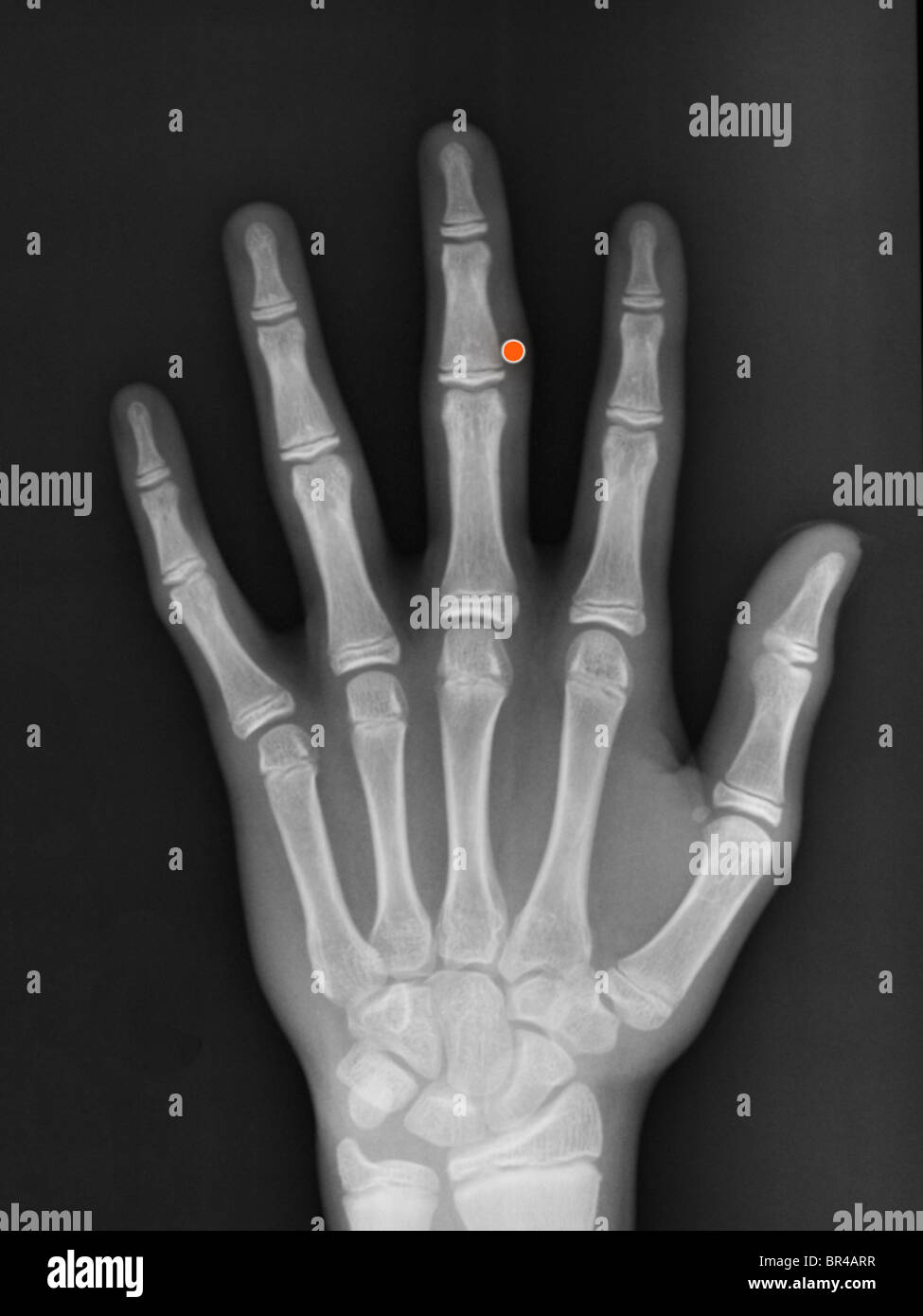 hand x-ray of a 12 year old boy who was shot in the middle finger with a BB gun Stock Photo