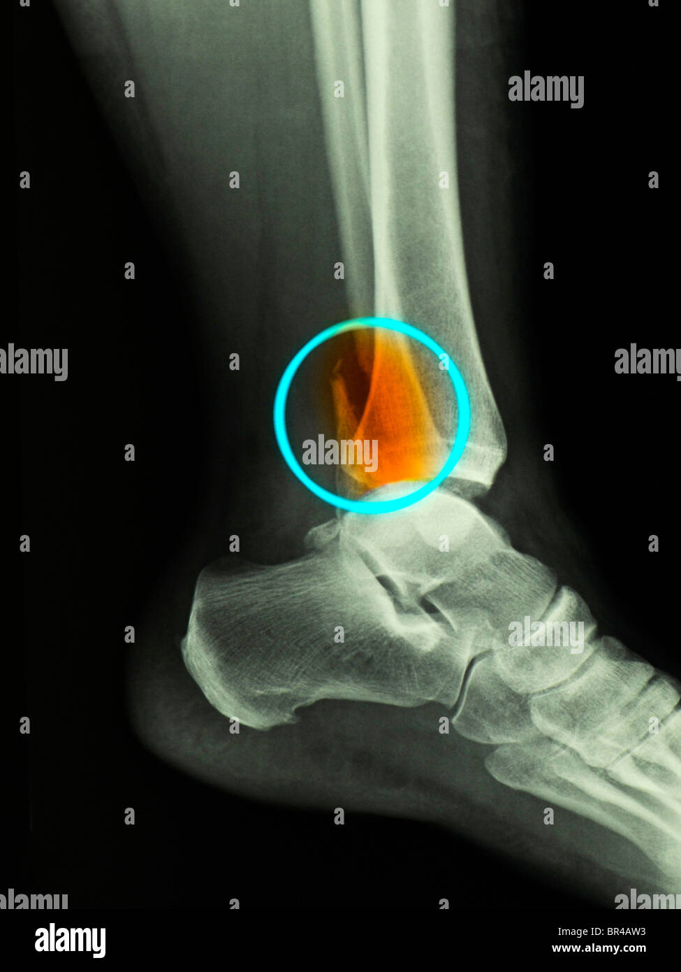 X-ray showing a bimalleolar ankle fracture in a 50 year old woman Stock Photo