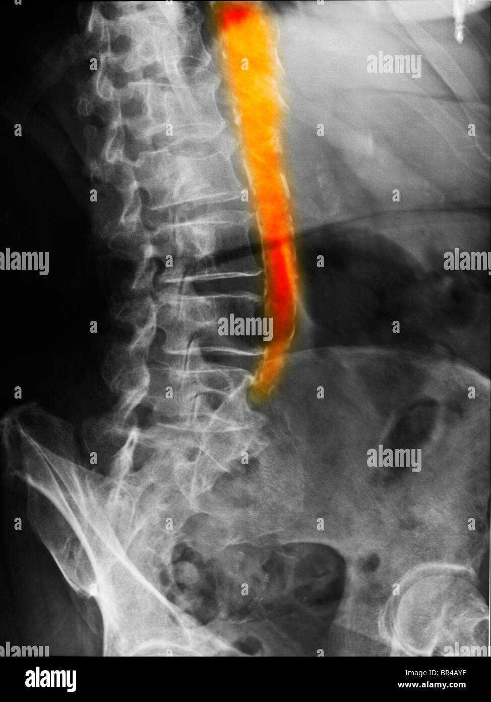 Calcified Abdominal Aorta