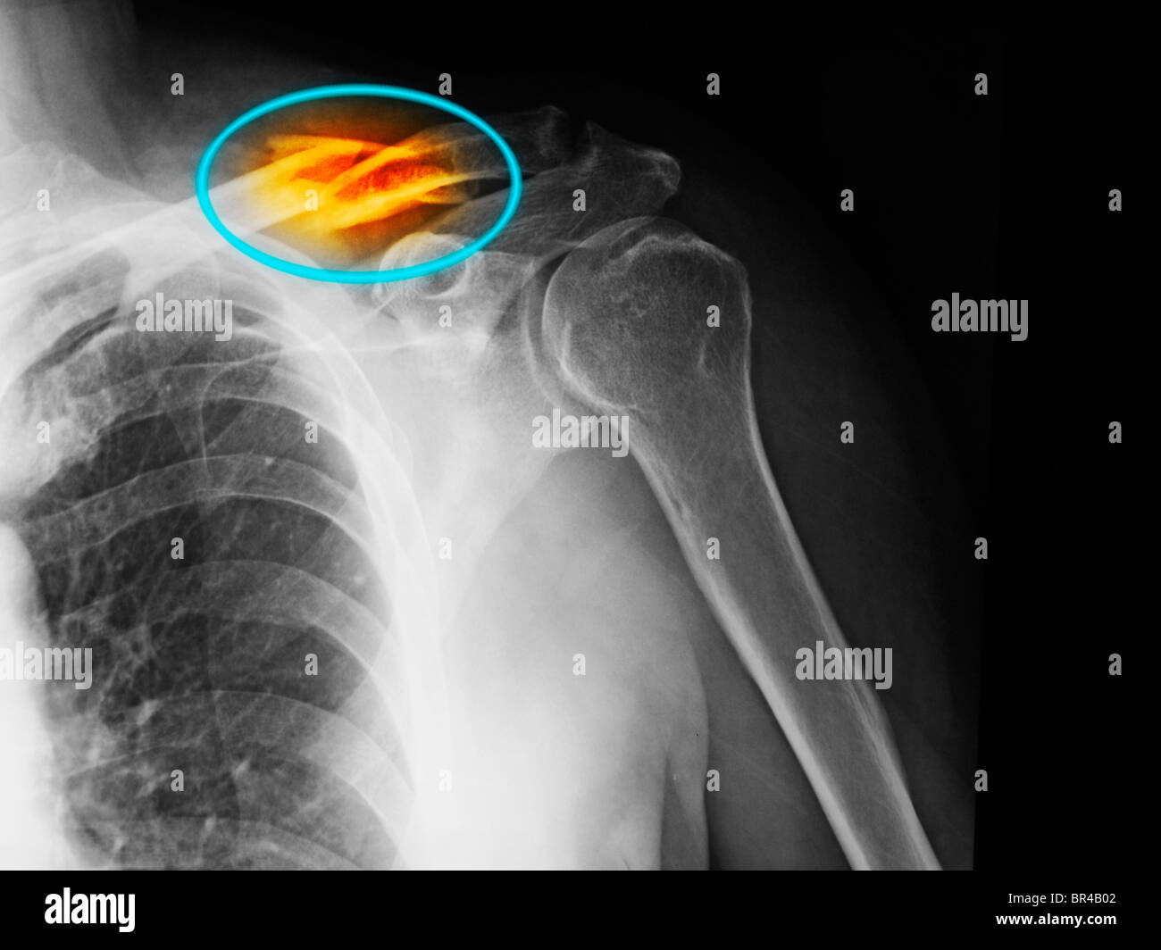 x-ray showing a clavicle fracture Stock Photo
