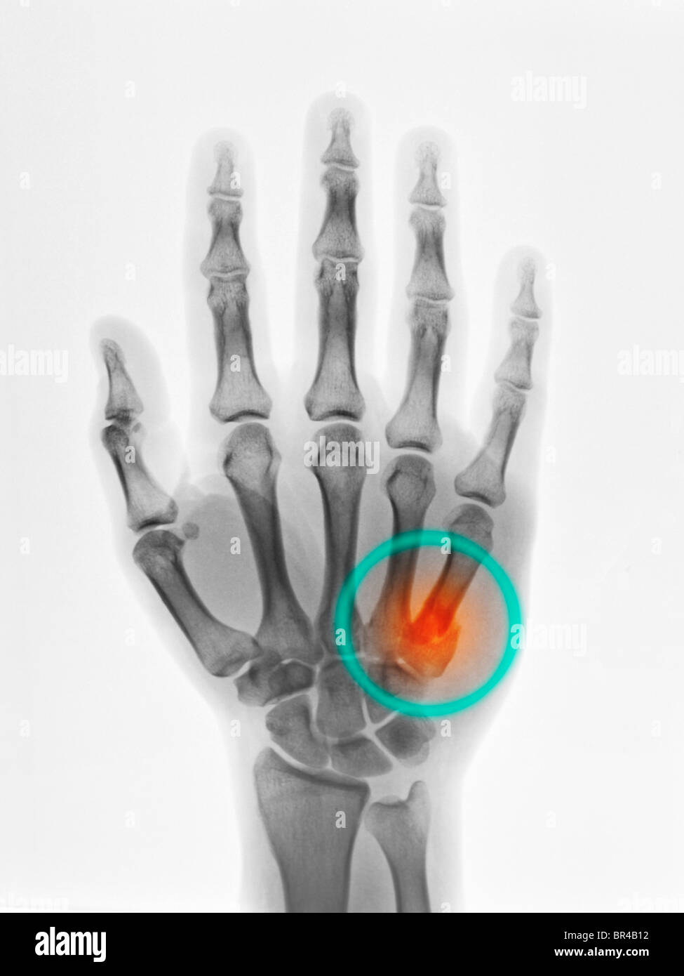 hand x-ray of a 29 year old man who fractured the base of the 5th metacarpal Stock Photo
