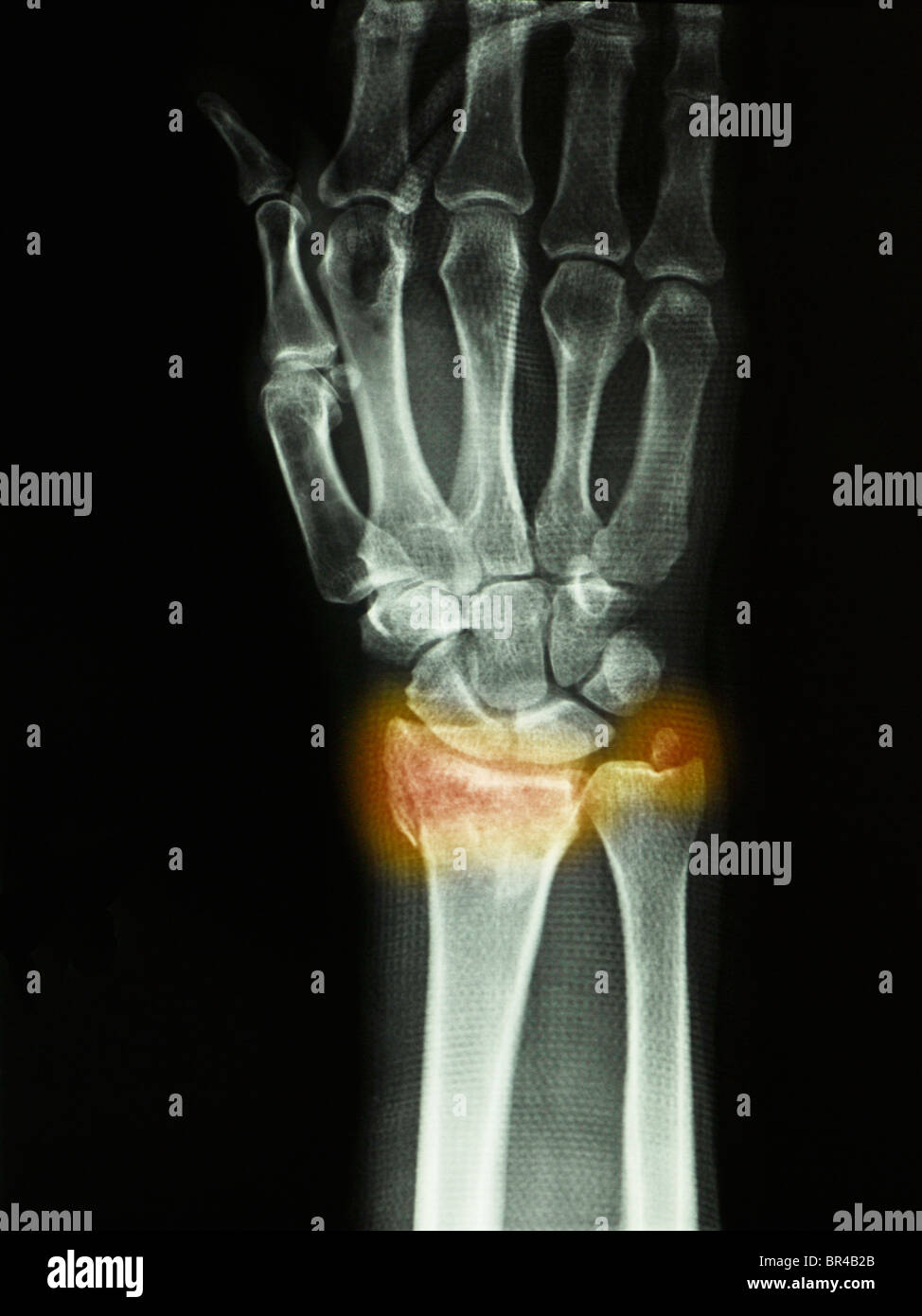 Distal radius and ulnar styloid fracture in a 43 year old man. Stock Photo