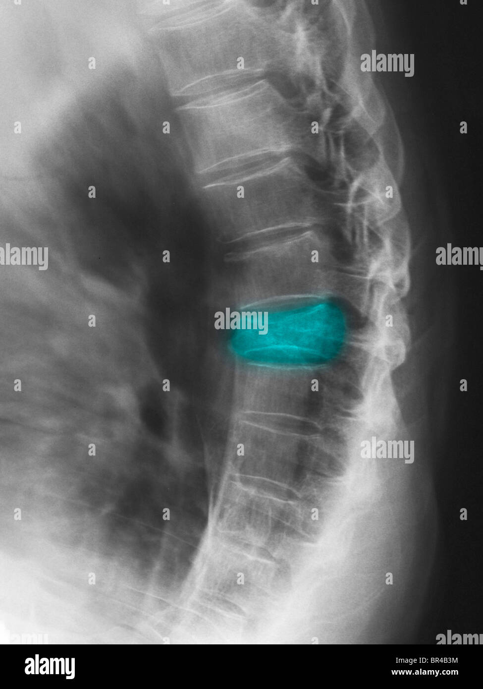 dorsal spine x-ray in lateral view showing a T7 compression fracture in a 77 year old man Stock Photo
