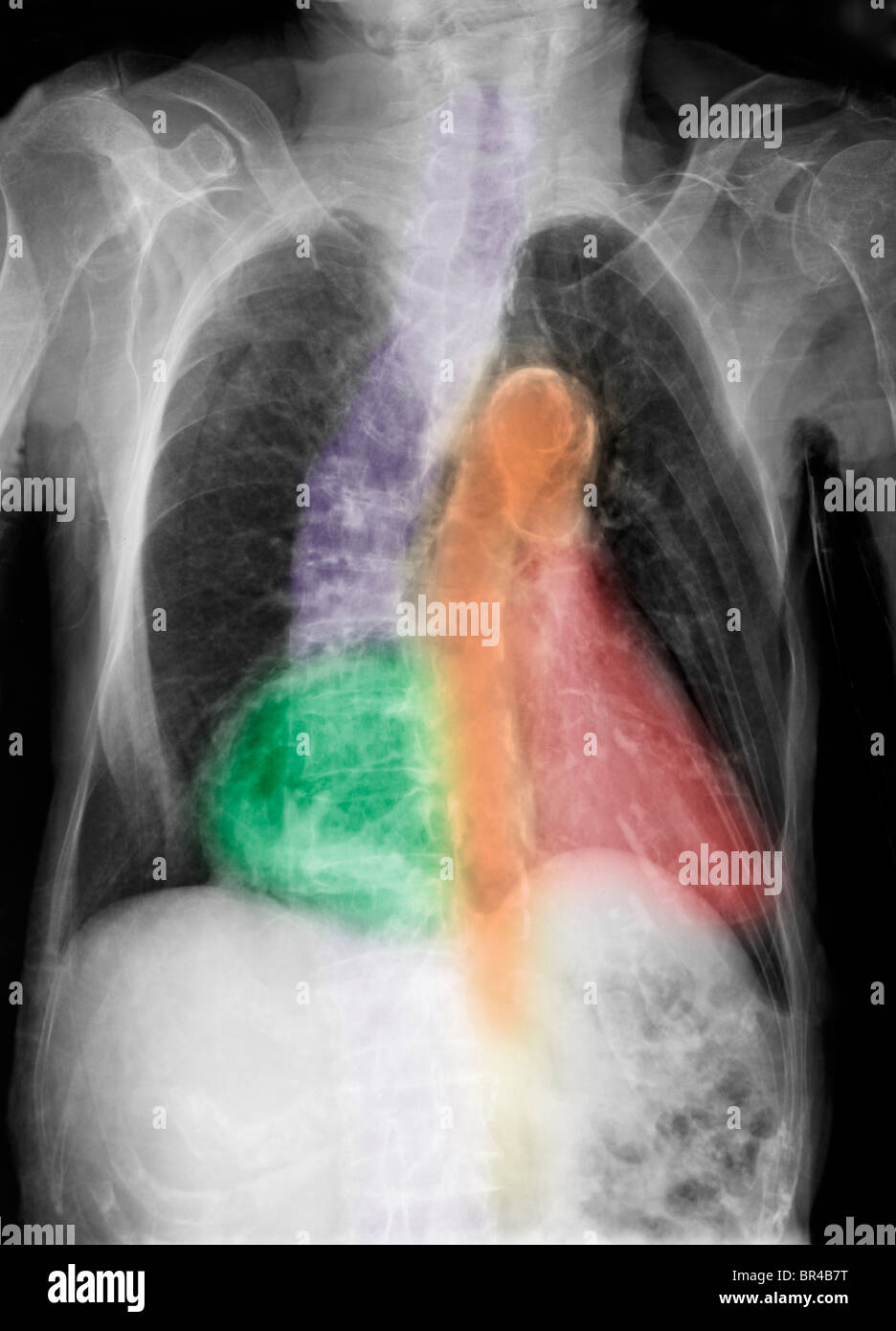 Hiatal Hernia Chest X Ray