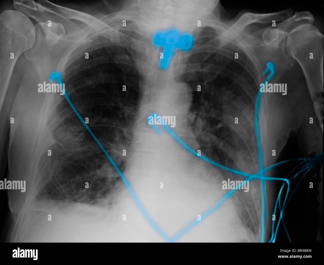 chest x-ray showing a tracheostomy in a 69 year old man. Stock Photo