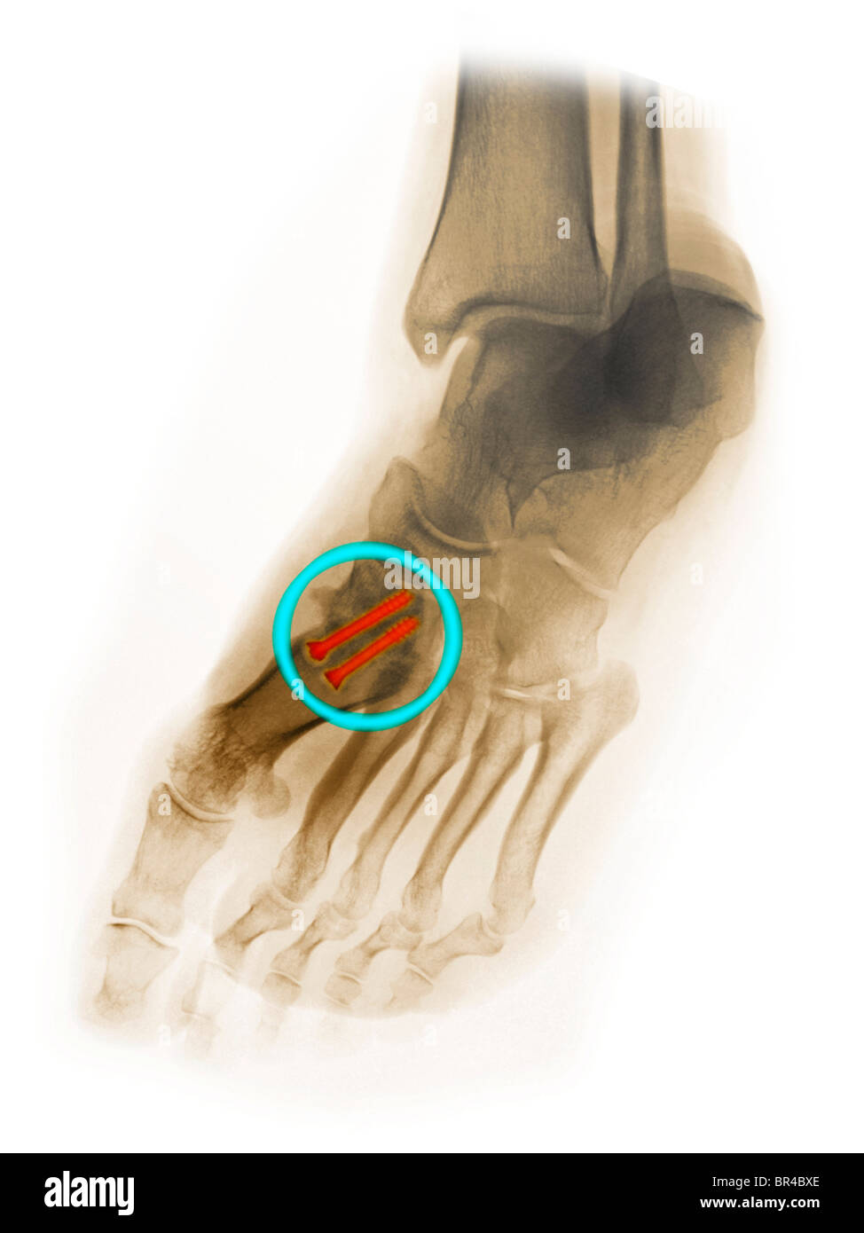 foot x-ray of a 30 year old man who had surgery of the first metatarsal with 2 screws fusing the metatarsal to the tarsal Stock Photo