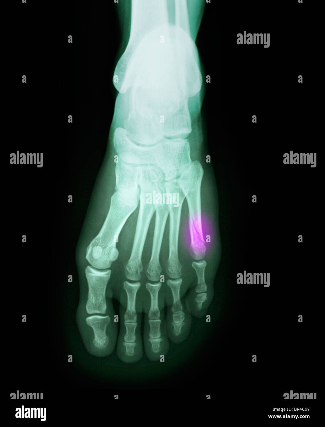 foot x-ray of a 37 year old female with a fractured 5th metatarsal Stock Photo