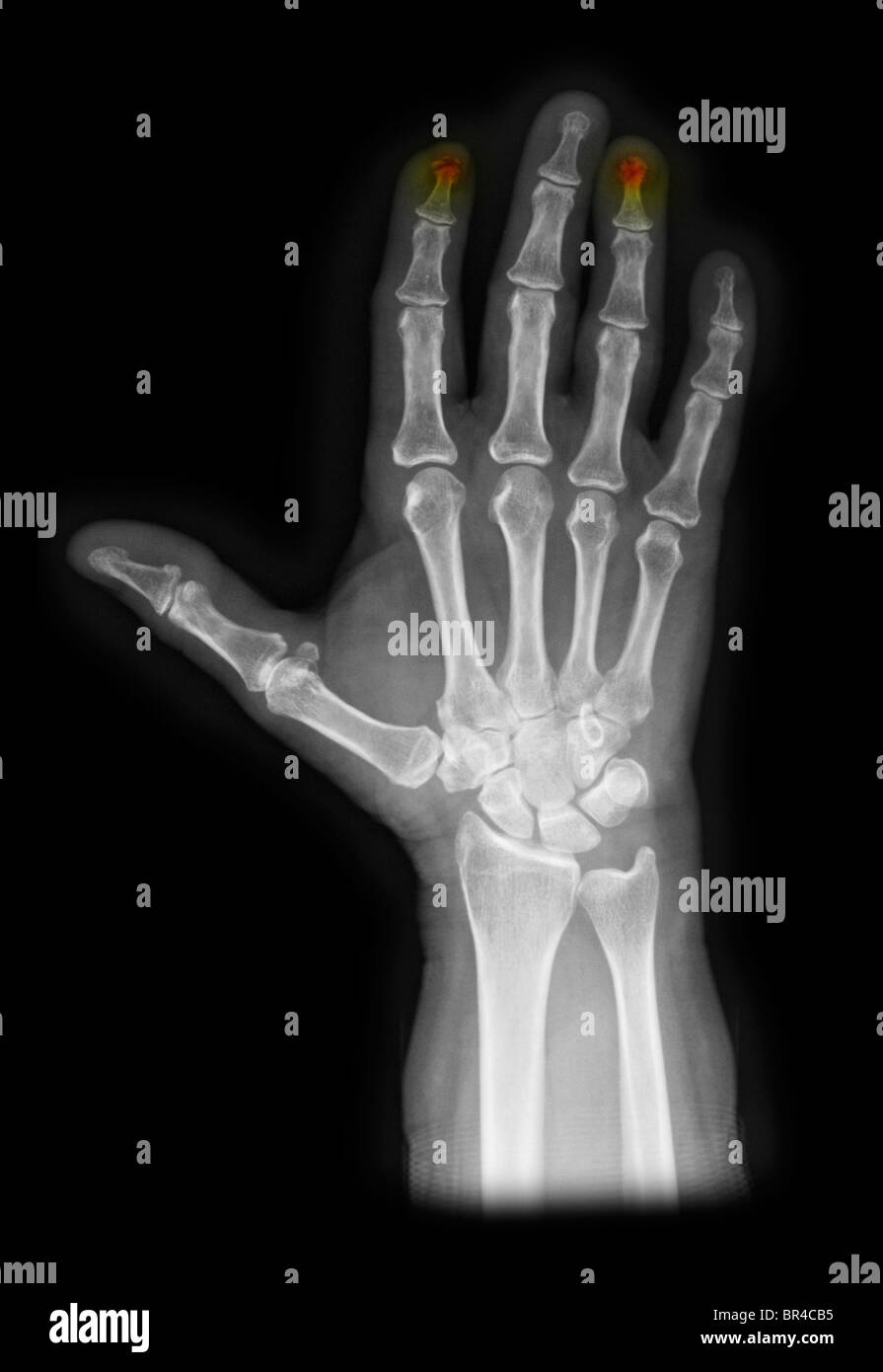 jammed finger xray jammed finger xray