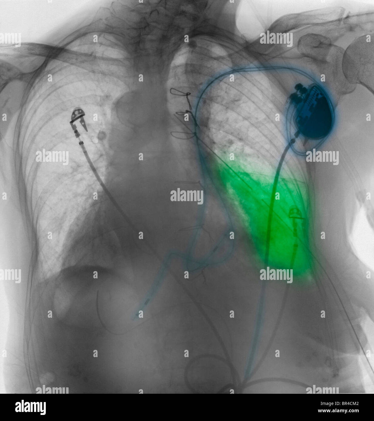 chest x-ray showing a pacemaker and an area of pneumonia in the left lower lobe of a 78 year old woman Stock Photo