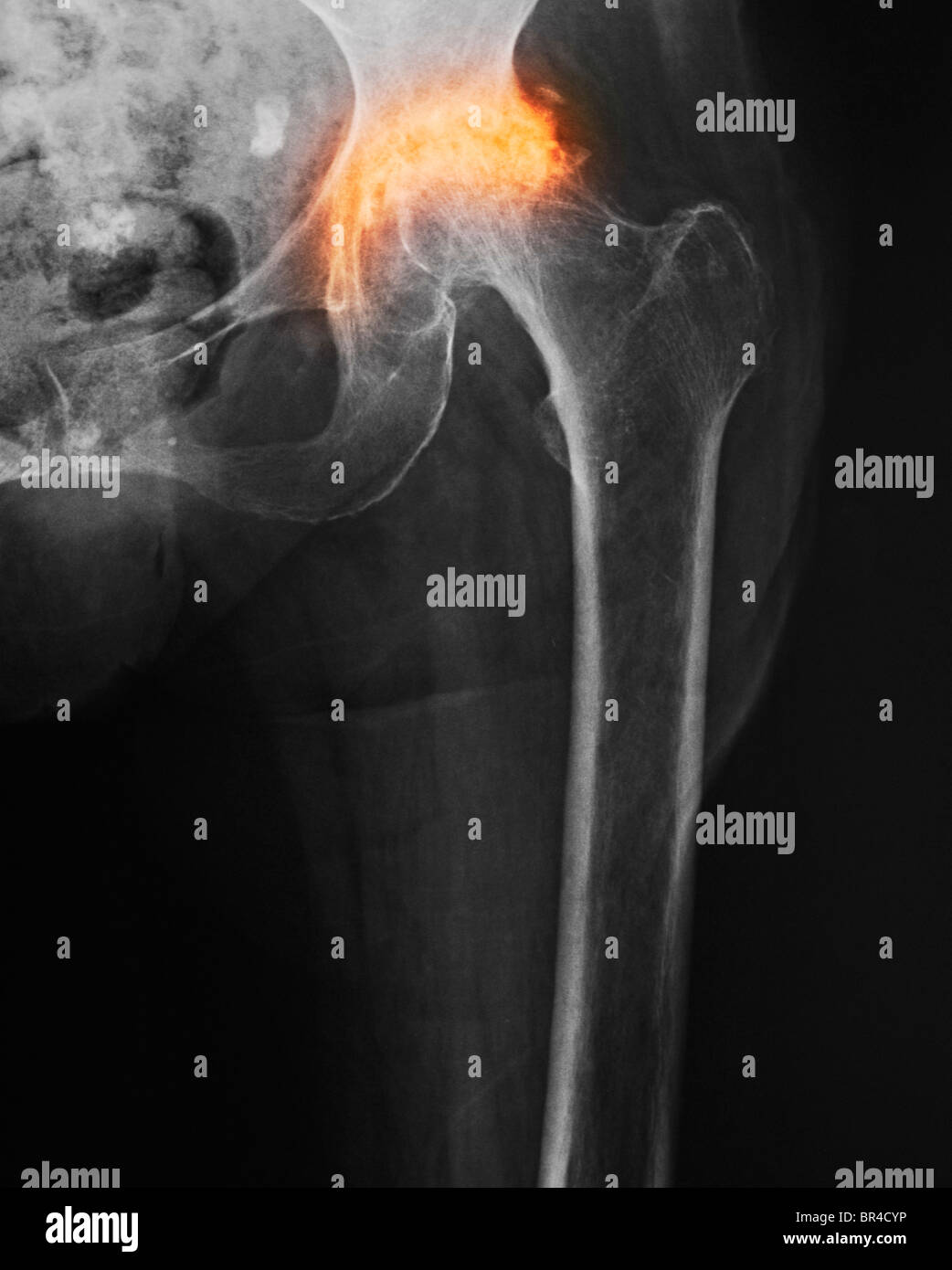 Hip osteoarthritis x ray hires stock photography and images Alamy