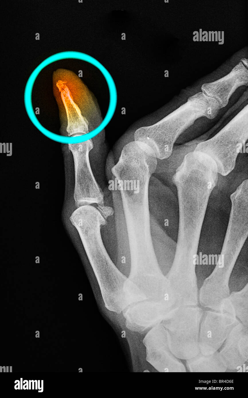 hand x-ray of a 68 year old man who fractured the tip of his thumb Stock Photo