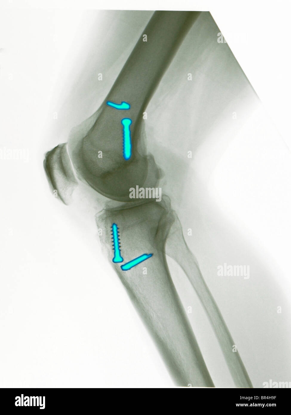colorized knee x-ray of a 45 year old man who had surgery to repair a torn ACL, anterior cruciate ligament. Stock Photo