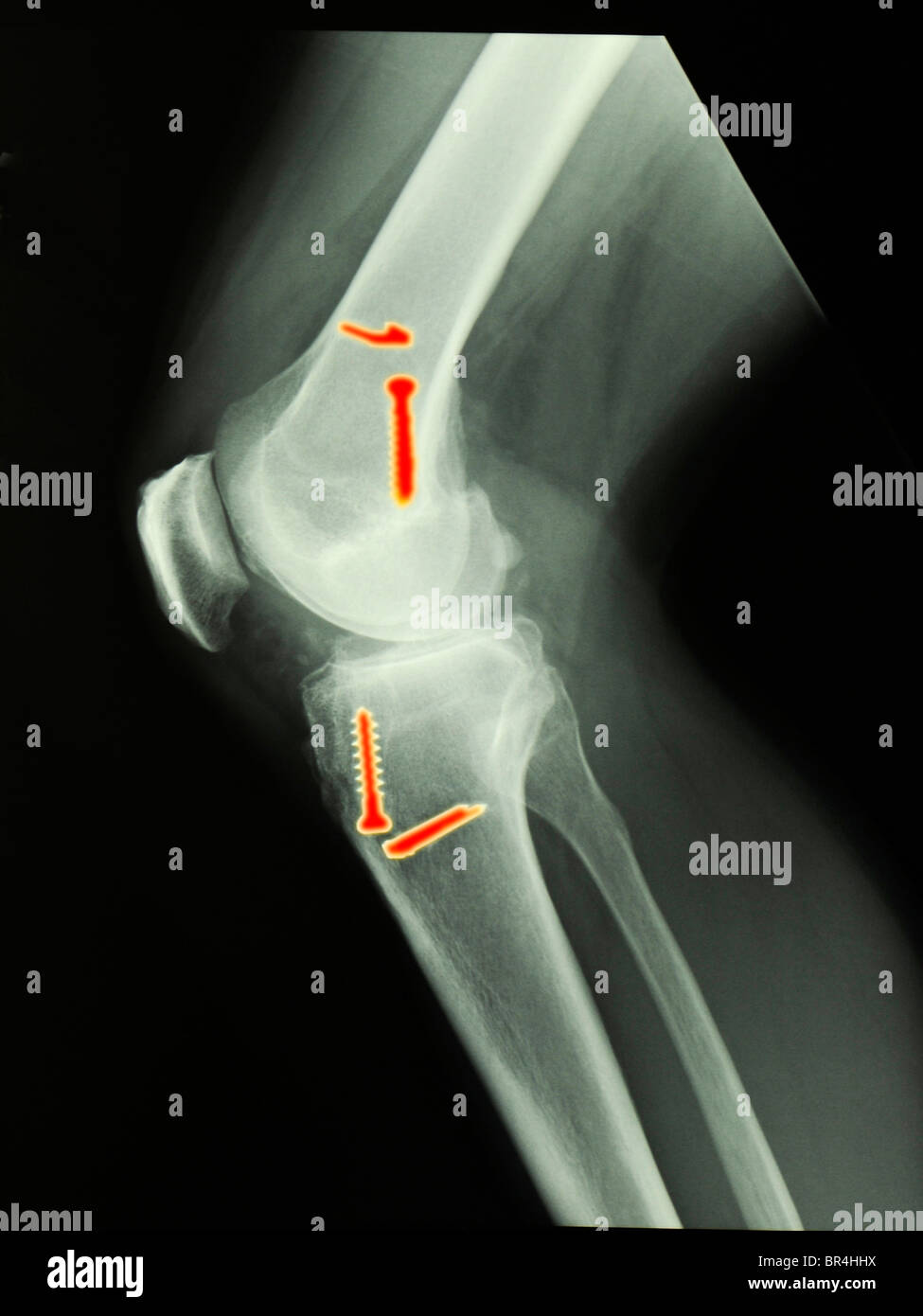 knee x-ray of a 45 year old man who had surgery to repair a torn ACL, anterior cruciate ligament Stock Photo