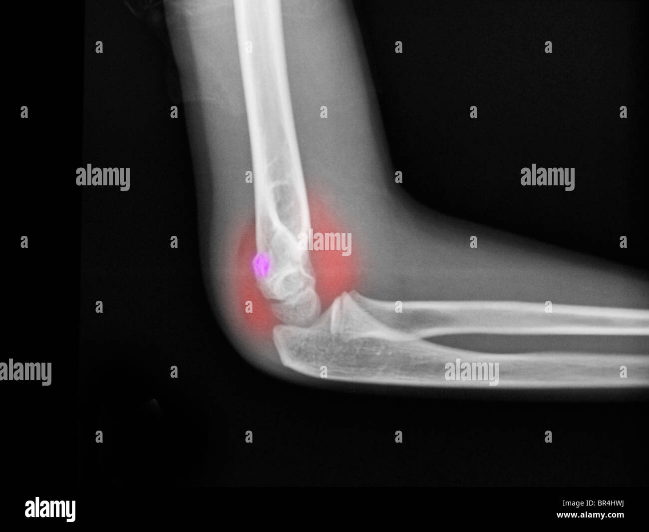 x-ray showing a distal humerus fracture in a 7 year old boy. Stock Photo