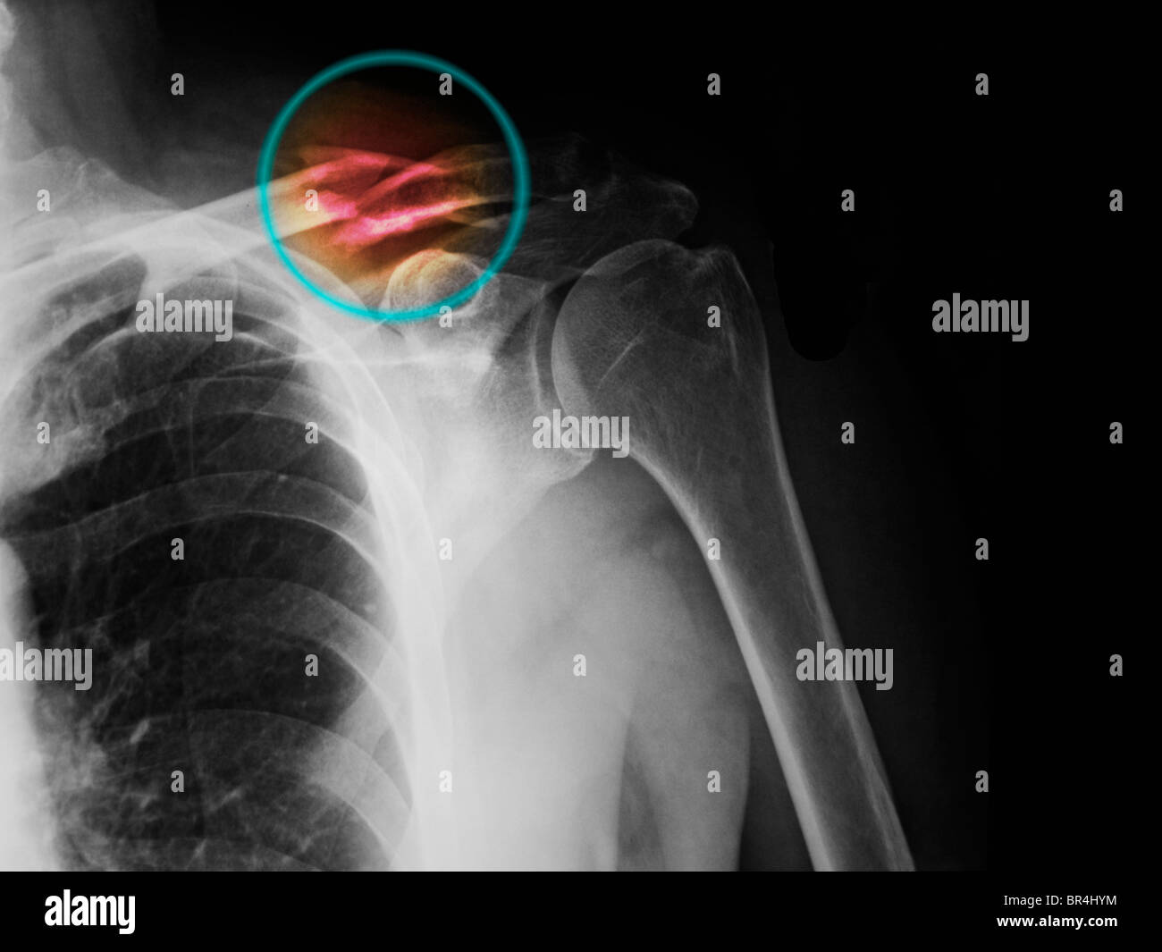 colorized x-ray of a collarbone fracture in a 62 year old man Stock Photo