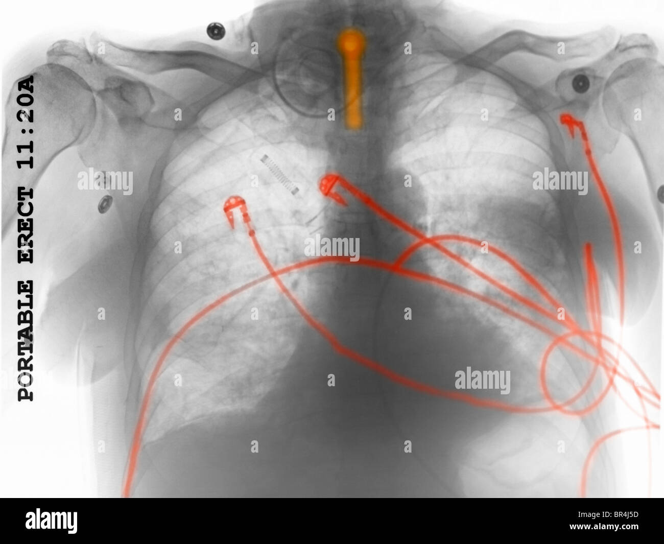 Chest x-ray of a 69 year old man intubated and with monitoring leads Stock Photo