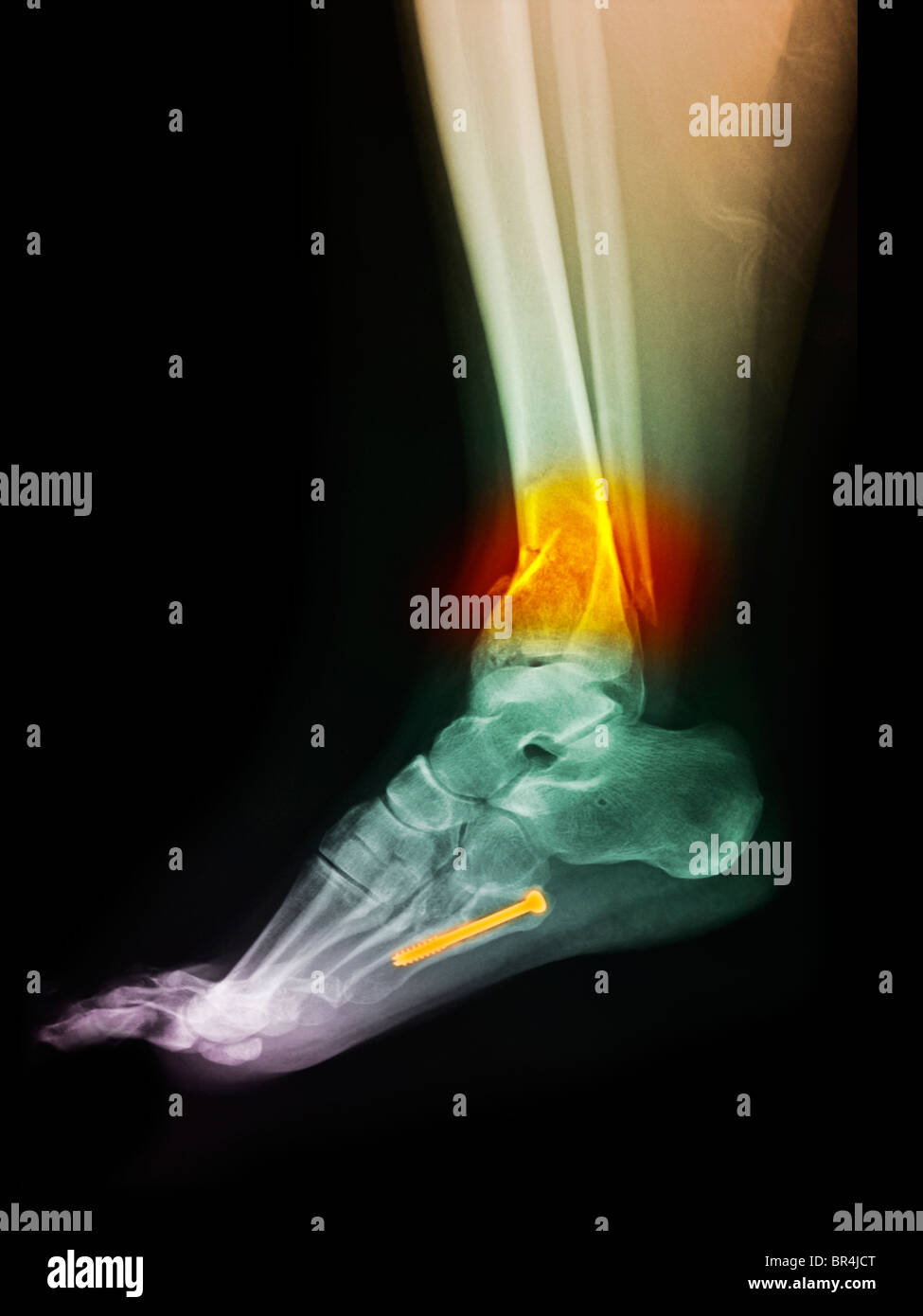 x-ray of the leg of a 43 year old woman who fractured her ankle Stock Photo