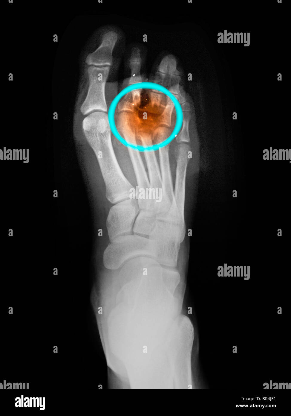 Foot x-ray of a 34 year old man who shot himself accidentally in the foot while cleaning his gun Stock Photo