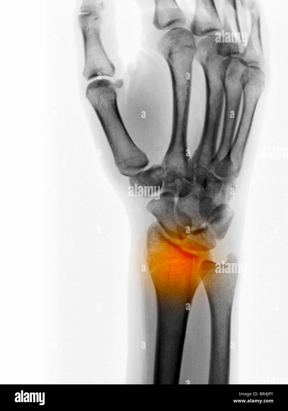 Forearm X ray Of A 29 Year Old Female Showing A Non displaced Fracture Forearm X ray Of A 29 Year Old Female Showing A Non displaced Fracture