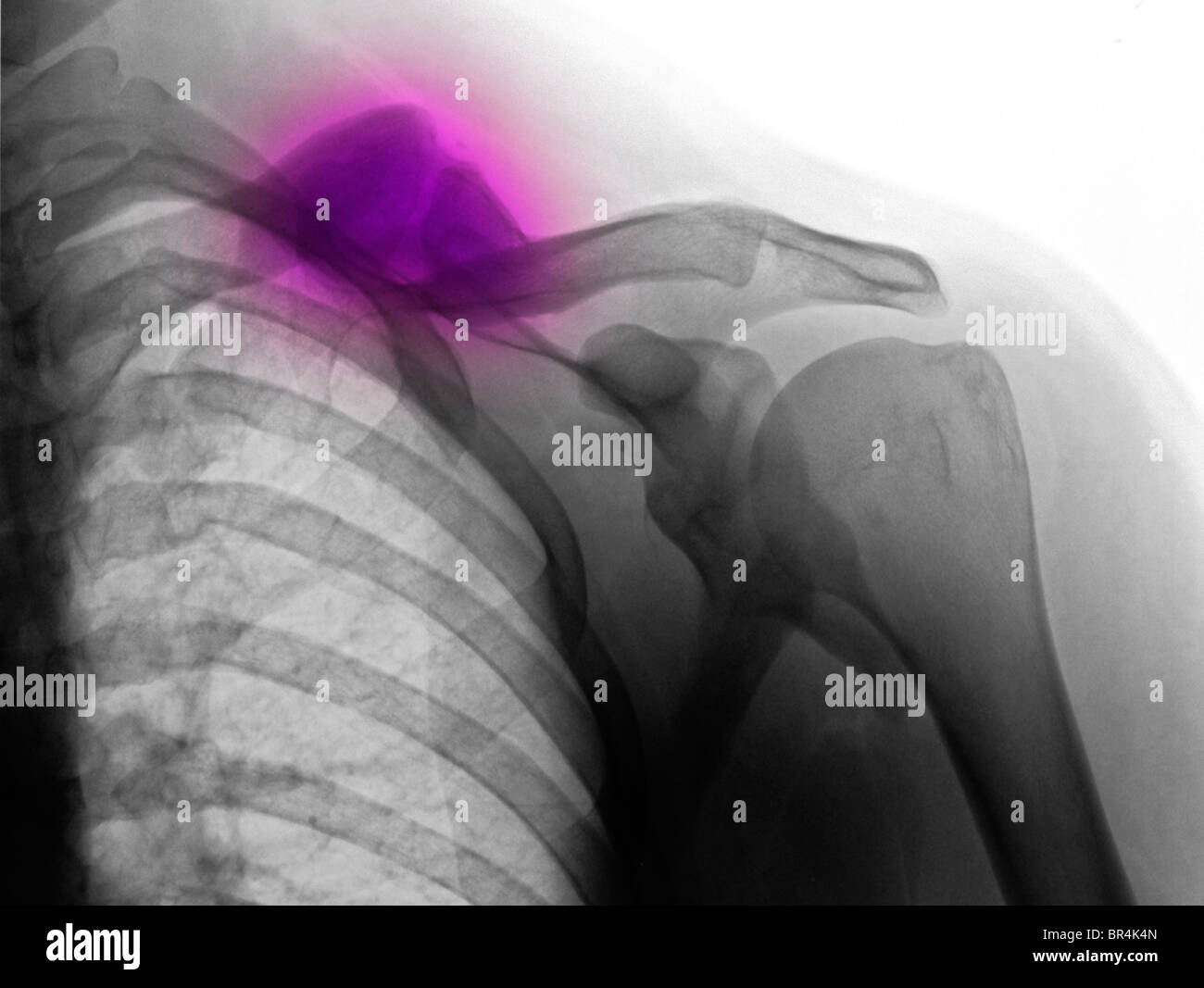 x-ray showing a healed fracture of the collarbone, clavicle, of a 34 year old man Stock Photo