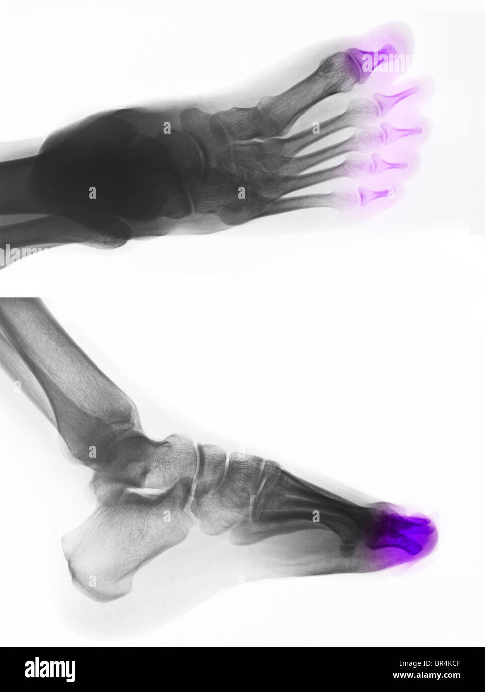 Foot x-ray of a 25 year old man showing congenital absence of the distal bones in the toes Stock Photo