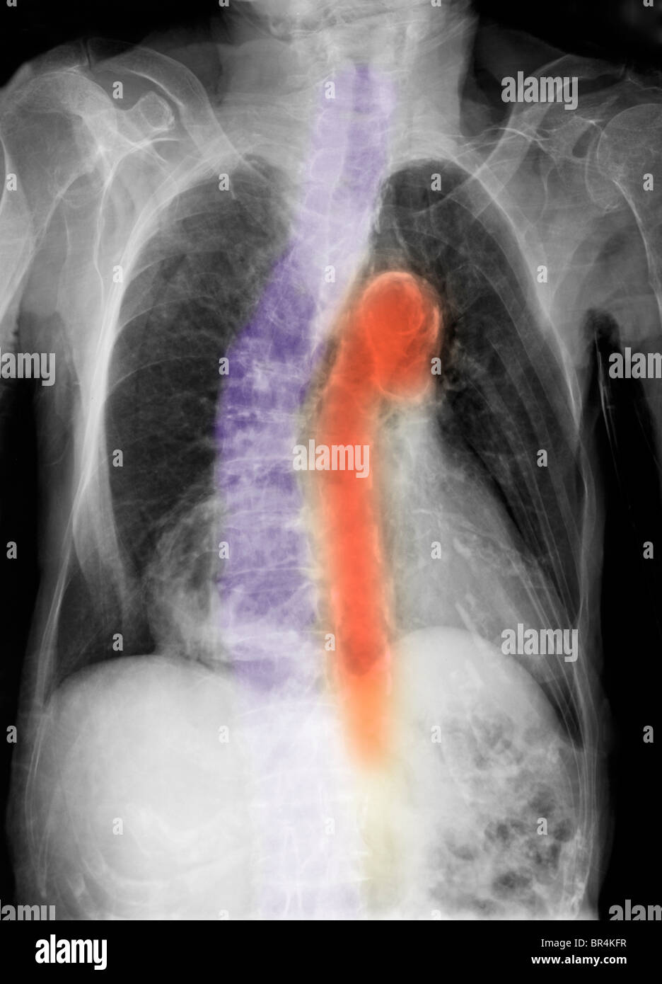 chest x-ray of a 96 year old woman with calcifications of the aorta, scoliosis and degenerative changes Stock Photo