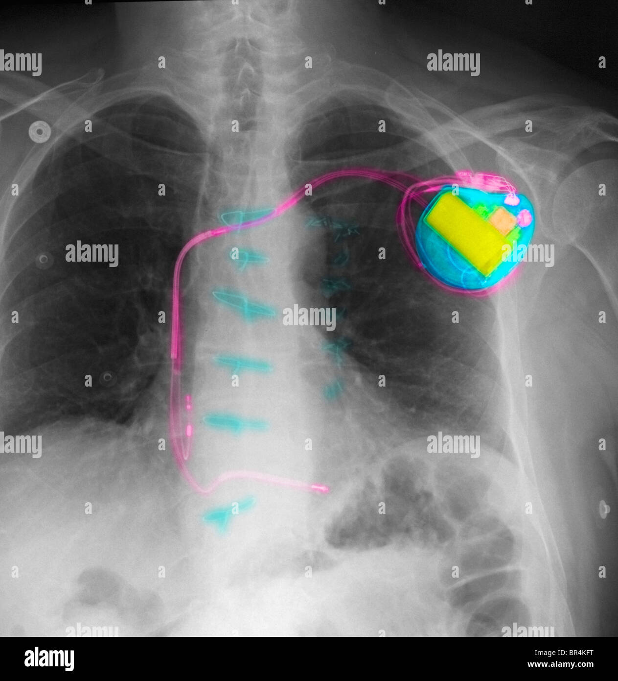 chest x-ray showing a pacemaker Stock Photo